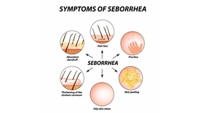 Symptoms,Of,Seborrhea.,Seborrhea,Skin,And,Hair.,Dandruff,,Seborrheic,Dermatitis.