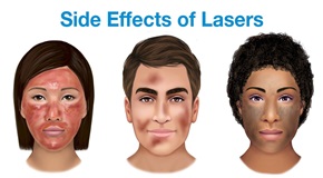 04-side-effects-of-lasers.jpg.5c7f441460a409871592bb6e326c8913