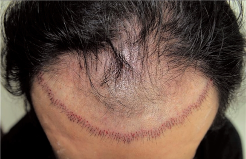 4-2. Recipient Site Planning for Hair Transplantation | D&PS
