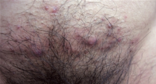 folliculitis genital area