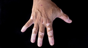 Quadrichrome vitiligo