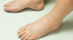Gross edema of leg and foot
