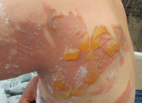 3. Management of Minor Burns