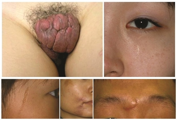 [Figure 2. Clinical patterns of various scars (keloid/mature scare/atrophic scar/immature scare/hypertrophic scar)]