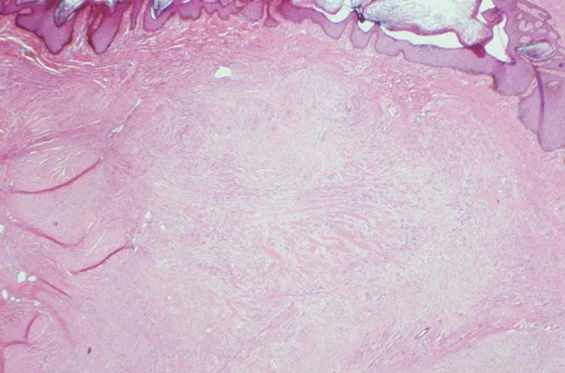 [Figure 3. Pathological finding of a keloid]