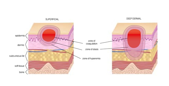 [Figure 5. Diagram showing zones of coagulation, stasis and hyperemia]