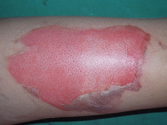 second degree burn yellow discharge