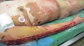 Escharotomy to prevent compartment syndrome from circumferential burn of the right upper arm