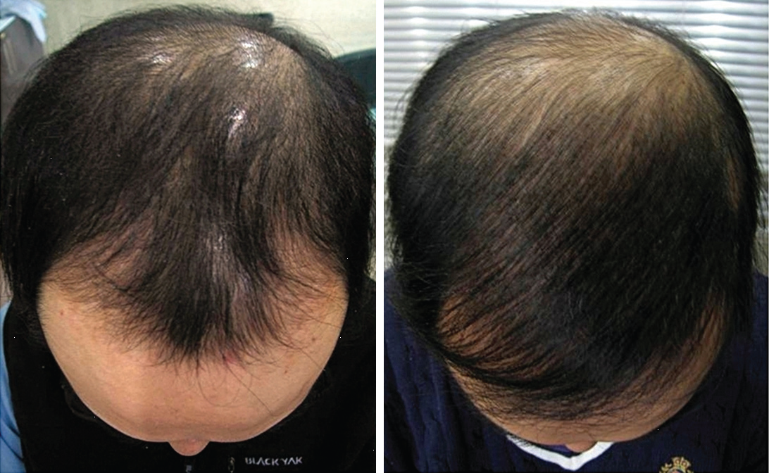 2. Combination of Medical and Surgical Treatments for Male Pattern and  Female Pattern Hair Loss | D&PS