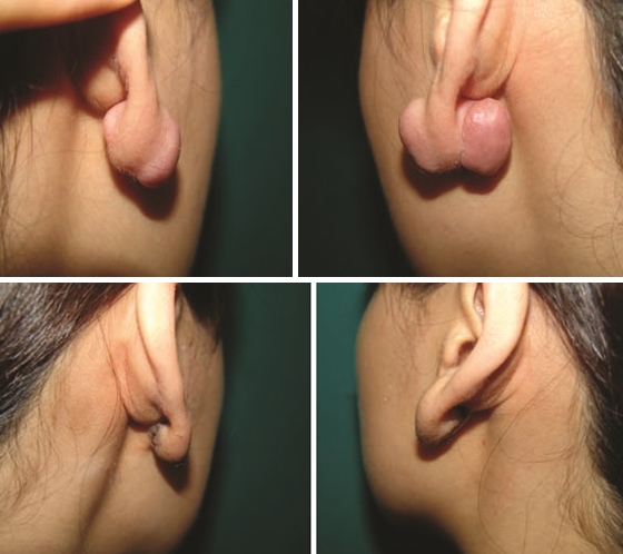 earlobe keloid removal