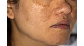 HYPERPIGMENTATION-290160