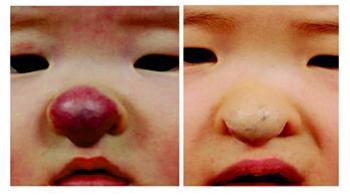 superficial hemangioma