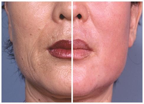 [laser resurfacing before and after (left shows skin before laser resurfacing, right shows skin after laser resurfacing)]