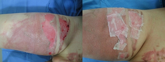 3. Management of Minor Burns