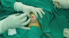 Removal of Multiple Lipomatosis_290_160