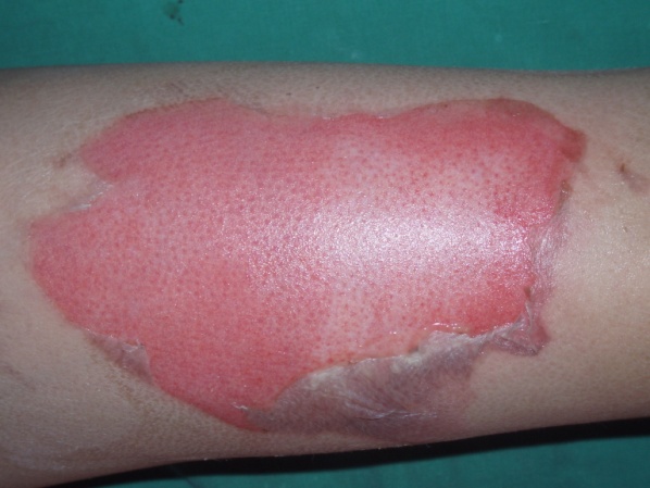 3. Management of Minor Burns