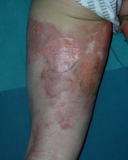 3. Management of Minor Burns