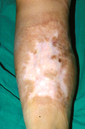 3. Management of Minor Burns