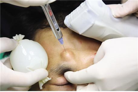 6. Preparation and Local Anesthesia before Hair Transplantation | D&PS