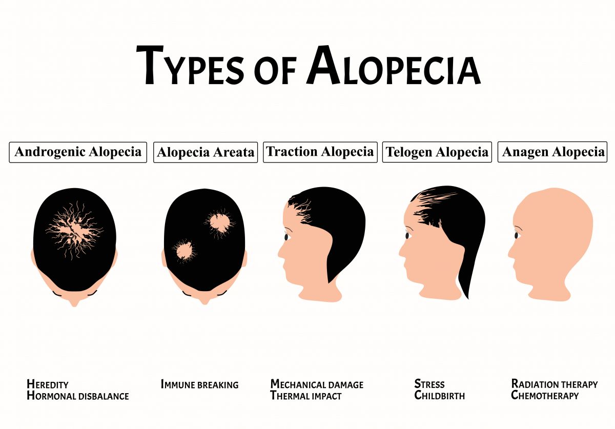 Alopecia totalis deals