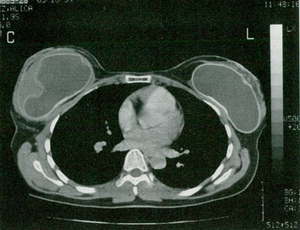 2-1. An Underestimated Risk of a Very Serious Complication, Breast Implant  Associated Anaplastic Large Cell Lymphoma